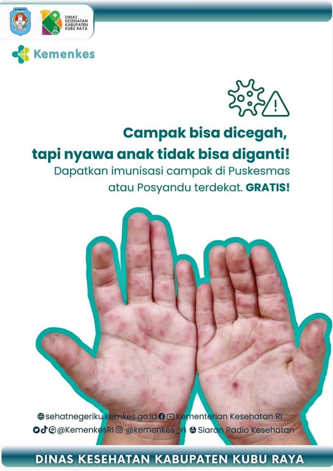 Kemenkes Waspadai Kasus Campak Nasional dan Mendunia